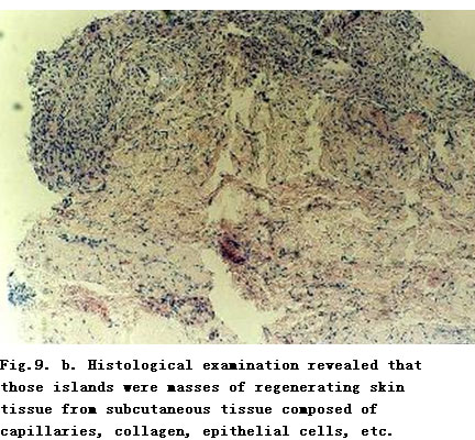 菲彩国际集团_Standardized Local Treatment of Burns Wounds