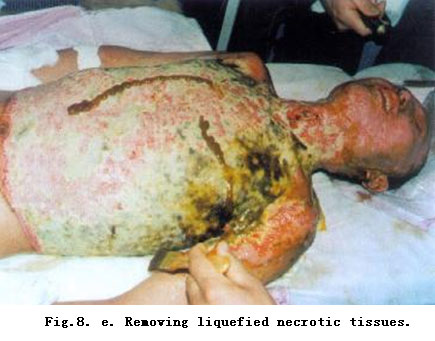 菲彩国际集团_Standardized Local Treatment of Burns Wounds