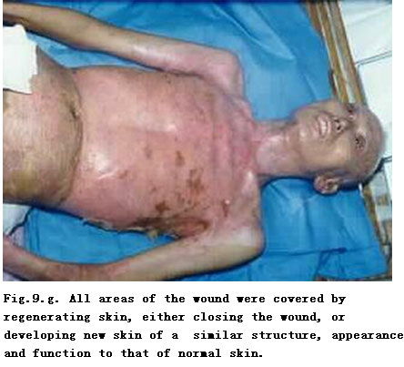 菲彩国际集团_Standardized Local Treatment of Burns Wounds