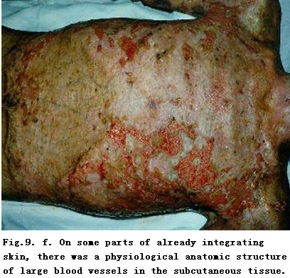 菲彩国际集团_Standardized Local Treatment of Burns Wounds