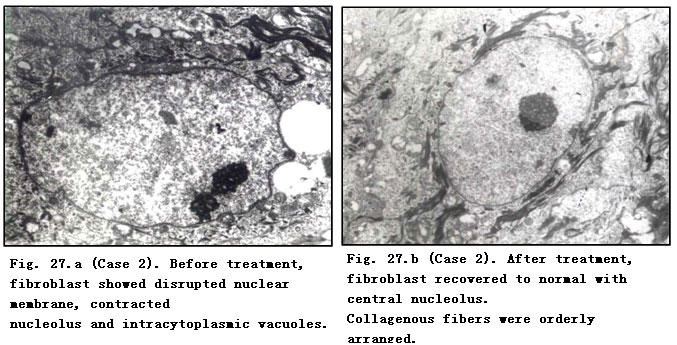 菲彩国际集团_Pathomorphological Changes of Deep Burns Wounds Treated with