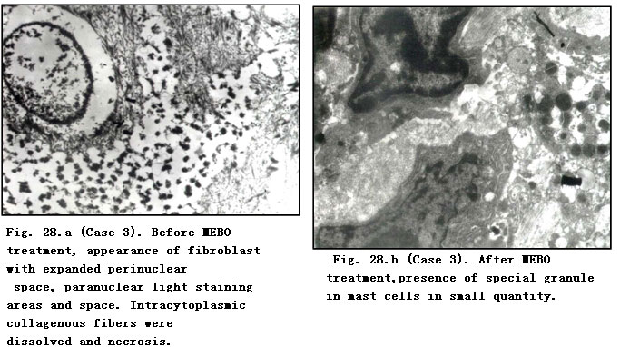 菲彩国际集团_Pathomorphological Changes of Deep Burns Wounds Treated with
