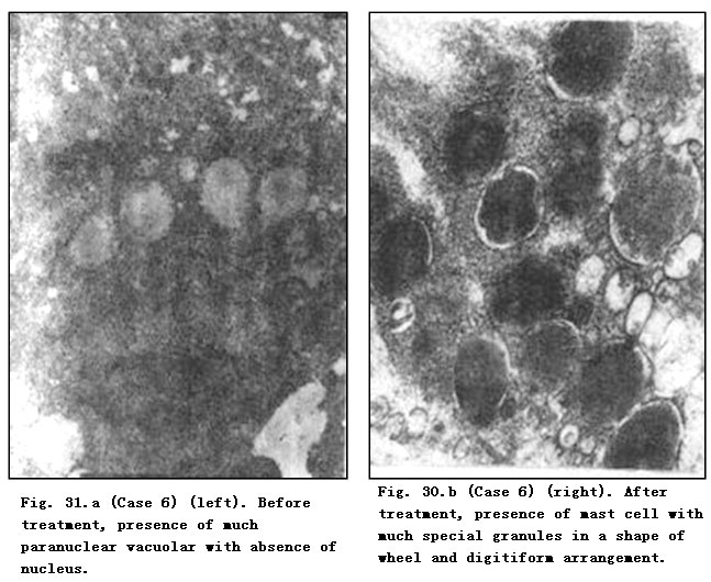 菲彩国际集团_Pathomorphological Changes of Deep Burns Wounds Treated with
