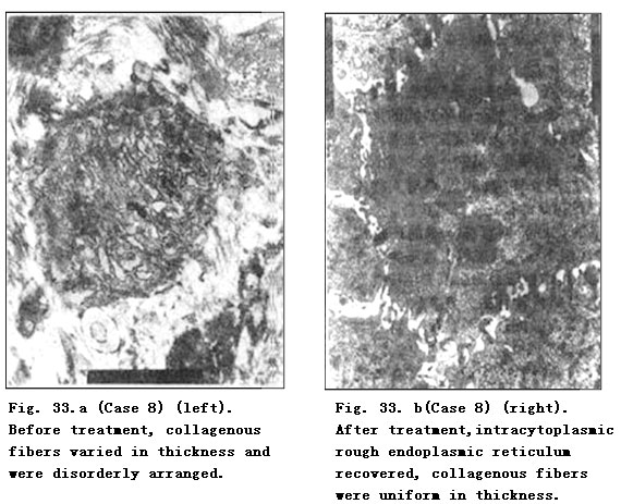 菲彩国际集团_Pathomorphological Changes of Deep Burns Wounds Treated with