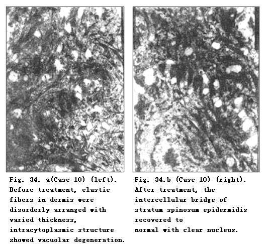 菲彩国际集团_Pathomorphological Changes of Deep Burns Wounds Treated with