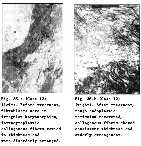 菲彩国际集团_Pathomorphological Changes of Deep Burns Wounds Treated with
