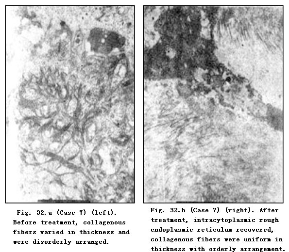 菲彩国际集团_Pathomorphological Changes of Deep Burns Wounds Treated with
