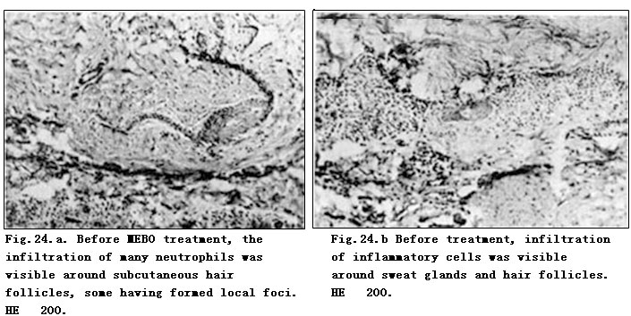 菲彩国际集团_Electron-Microscopic Observation of One Case of Skins Burns