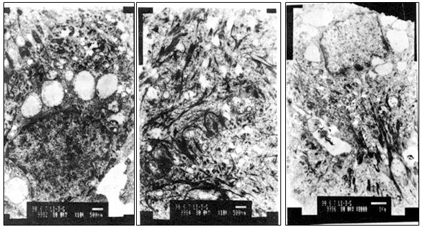 菲彩国际集团_Electron-Microscopic Observation of One Case of Skins Burns