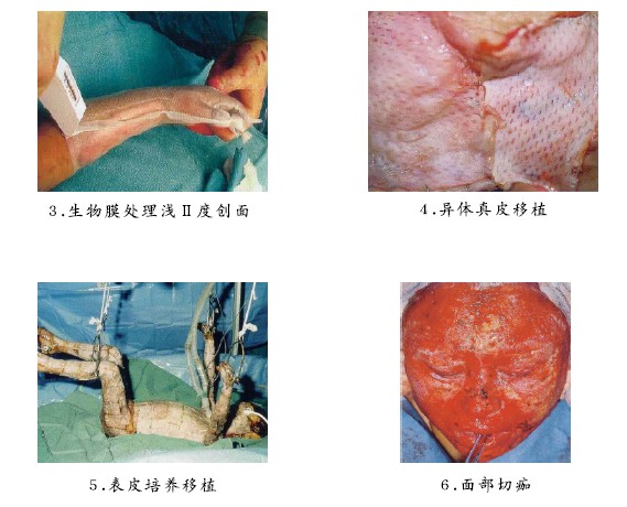 菲彩国际集团_二、古板烧伤外科植皮手艺举例（图示）