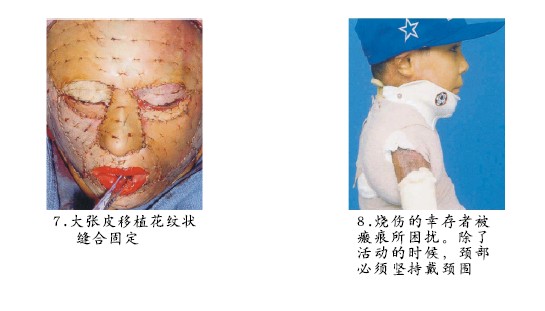菲彩国际集团_二、古板烧伤外科植皮手艺举例（图示）