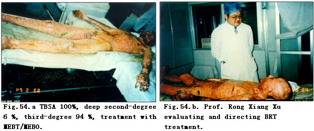 菲彩国际集团_Clinical Demonstrations of Burns Regenerative Medicine and T