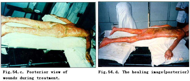菲彩国际集团_Clinical Demonstrations of Burns Regenerative Medicine and T