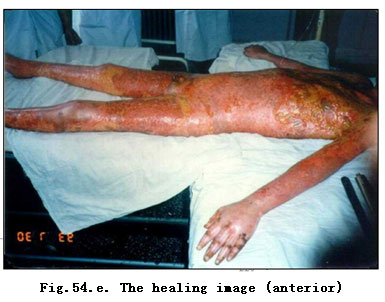 菲彩国际集团_Clinical Demonstrations of Burns Regenerative Medicine and T