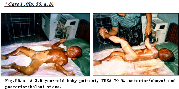 菲彩国际集团_Extensive Burn Cases with Most Wounds of Superficial Partial