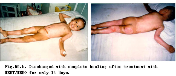 菲彩国际集团_Extensive Burn Cases with Most Wounds of Superficial Partial