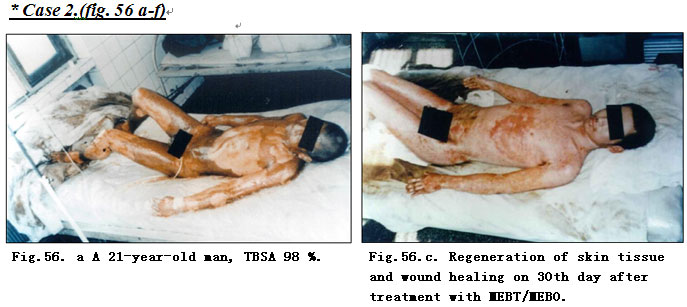 菲彩国际集团_Extensive Burns Cases with Most Wounds of Deep Partial-Thick