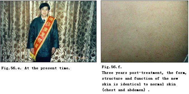 菲彩国际集团_Extensive Burns Cases with Most Wounds of Deep Partial-Thick
