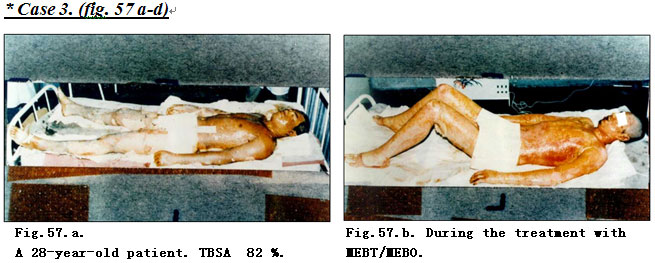 菲彩国际集团_Extensive Burns Cases with Most Wounds of Deep Partial-Thick