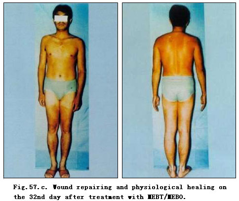 菲彩国际集团_Extensive Burns Cases with Most Wounds of Deep Partial-Thick