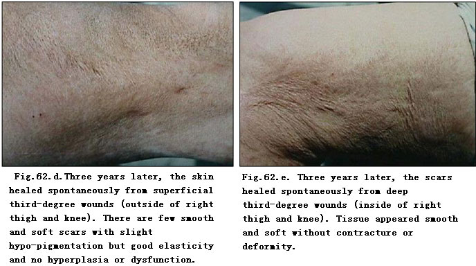 菲彩国际集团_Extensive Burns Cases with Most Wounds of Full-Thickness