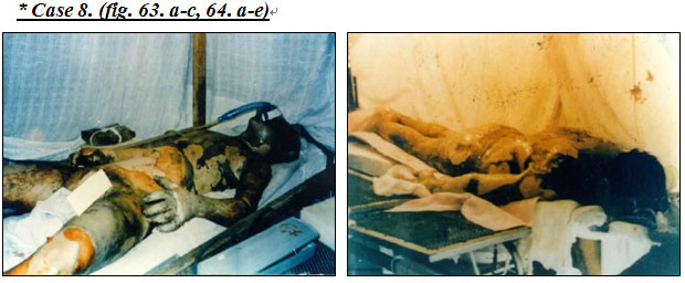 菲彩国际集团_Extensive Burns Cases with Most Wounds of Full-Thickness