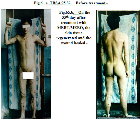 菲彩国际集团_Extensive Burns Cases with Most Wounds of Full-Thickness