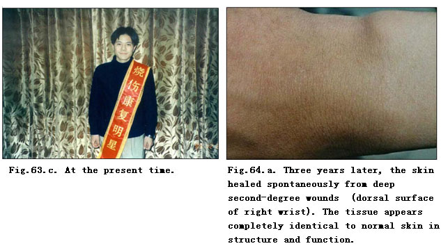 菲彩国际集团_Extensive Burns Cases with Most Wounds of Full-Thickness