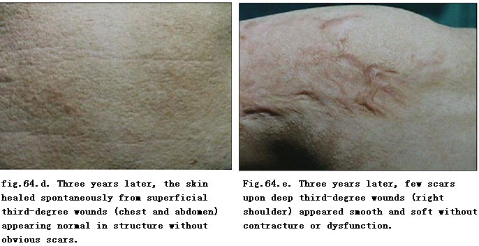 菲彩国际集团_Extensive Burns Cases with Most Wounds of Full-Thickness