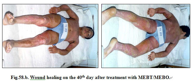 菲彩国际集团_Extensive Burns Cases with Most Wounds of Full-Thickness