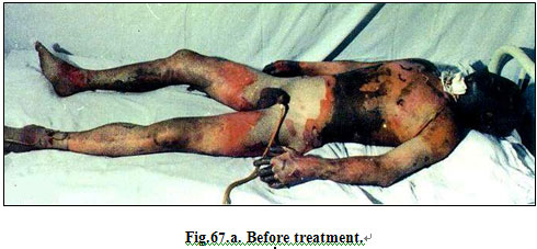 菲彩国际集团_Clinical results of Surgical Excision and Skin Grafting Ther