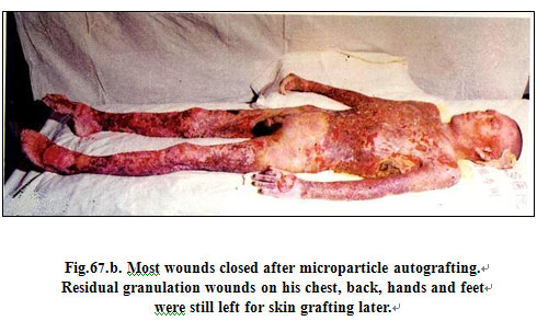 菲彩国际集团_Clinical results of Surgical Excision and Skin Grafting Ther
