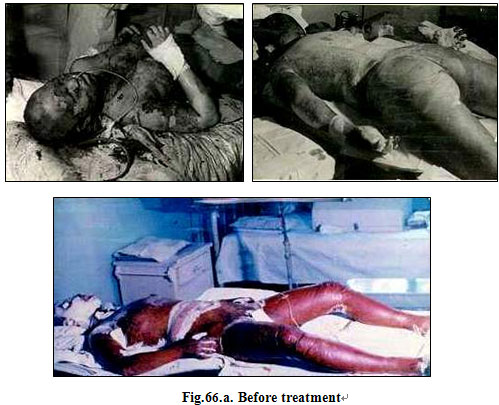 菲彩国际集团_Clinical results of Surgical Excision and Skin Grafting Ther