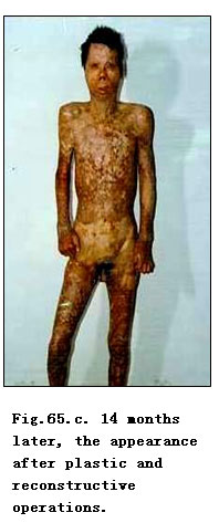 菲彩国际集团_Clinical results of Surgical Excision and Skin Grafting Ther