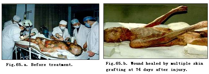菲彩国际集团_Clinical results of Surgical Excision and Skin Grafting Ther