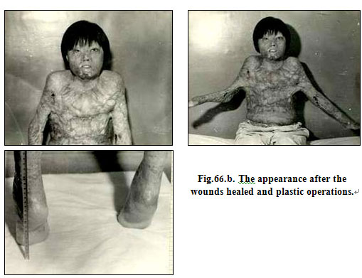 菲彩国际集团_Clinical results of Surgical Excision and Skin Grafting Ther