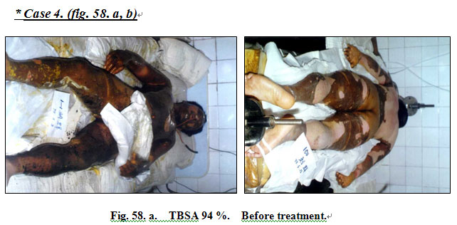 菲彩国际集团_Extensive Burns Cases with Most Wounds of Full-Thickness