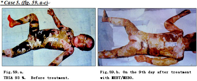 菲彩国际集团_Extensive Burns Cases with Most Wounds of Full-Thickness