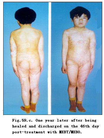 菲彩国际集团_Extensive Burns Cases with Most Wounds of Full-Thickness