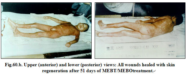 菲彩国际集团_Extensive Burns Cases with Most Wounds of Full-Thickness