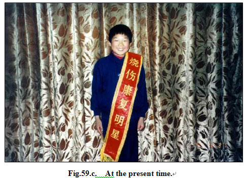 菲彩国际集团_Extensive Burns Cases with Most Wounds of Full-Thickness