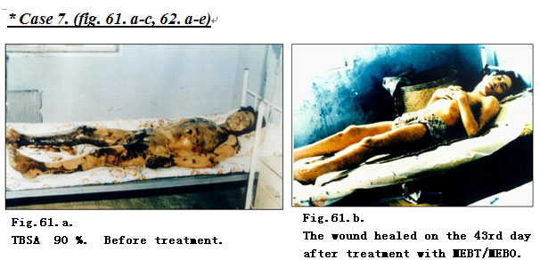 菲彩国际集团_Extensive Burns Cases with Most Wounds of Full-Thickness