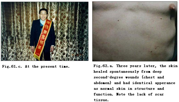 菲彩国际集团_Extensive Burns Cases with Most Wounds of Full-Thickness