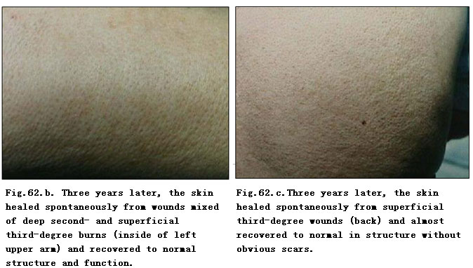 菲彩国际集团_Extensive Burns Cases with Most Wounds of Full-Thickness