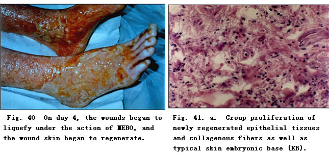 菲彩国际集团_Clinical Procedure and Histological Observation of Full-Thic