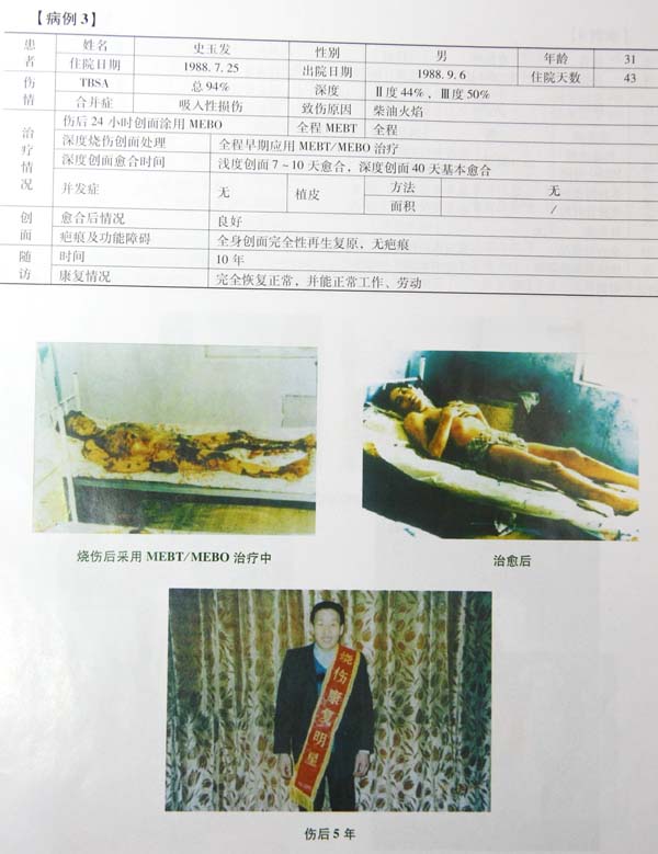 菲彩国际集团_第五节 烧伤皮肤系统再生治疗手艺病例先容