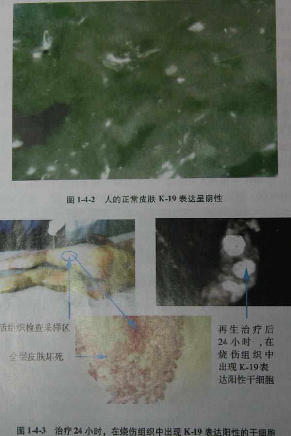 菲彩国际集团_第二节 四肢热挤压伤治疗手艺