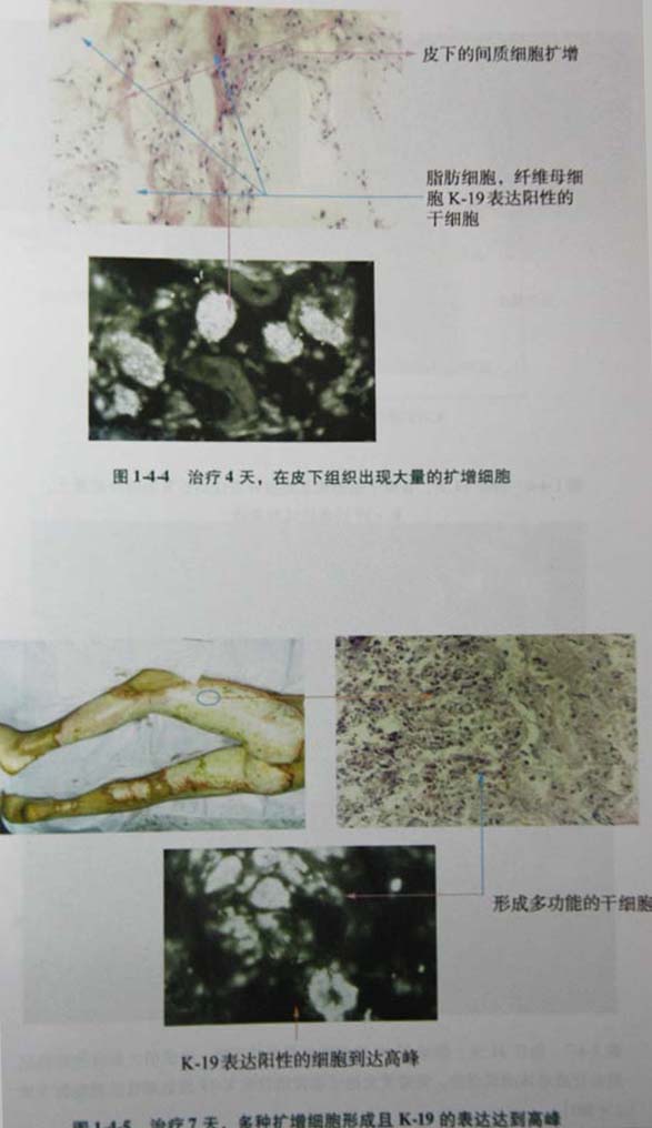 菲彩国际集团_第二节 四肢热挤压伤治疗手艺