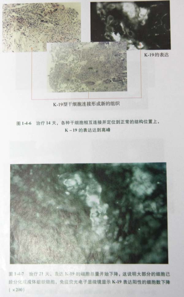 菲彩国际集团_第二节 四肢热挤压伤治疗手艺