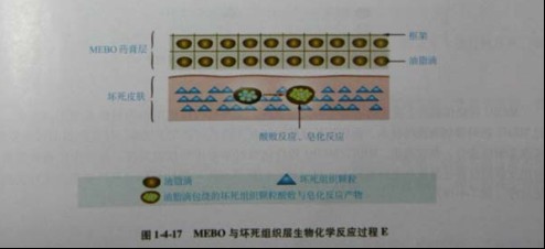 菲彩国际集团_第三节 烧伤创面坏死组织液化扫除与实验要领